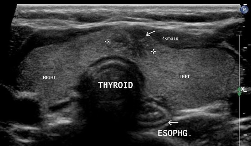 Mobile Thyroid Ultrasound