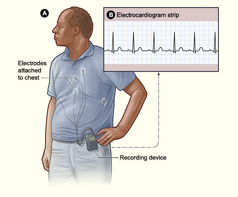 What Can a Holter Monitor Detect?