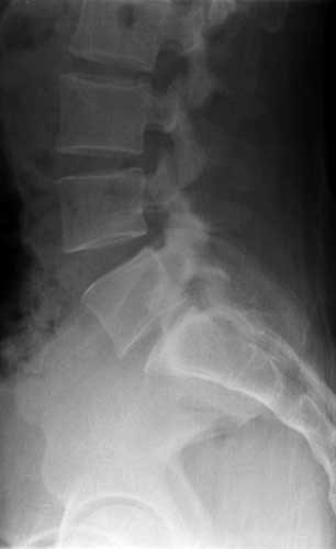 Mobile Spinal X-Ray